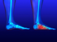 Flat Feet May Affect Ankle Mobility