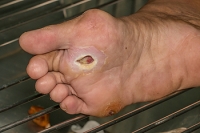 Foot Ulcers and Proper Treatment