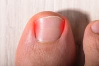 Types and Common Causes of Ingrown Toenails