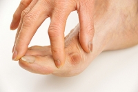 Shoes And Genetics May Cause Bunions