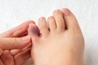 Toe Pain and the Impact of a Broken Toe